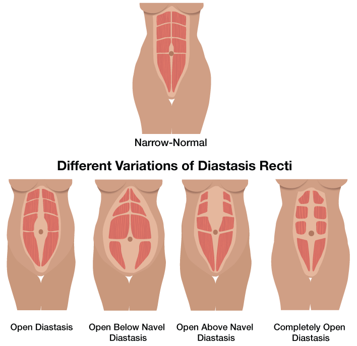 diastasis recti divarication